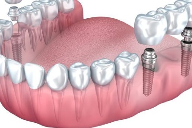 Common Misconceptions About Dental Implants