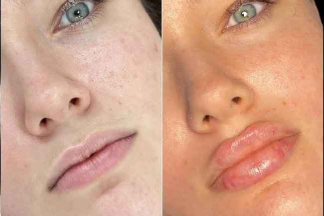 Fillers Treatments in Dubai for a Lifted and Contoured Face