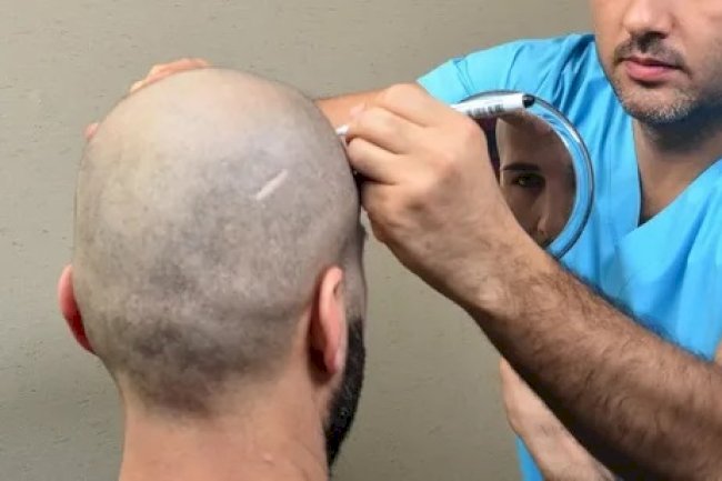 Hair Transplant in Dubai – Restore Hair. Reclaim Confidence.