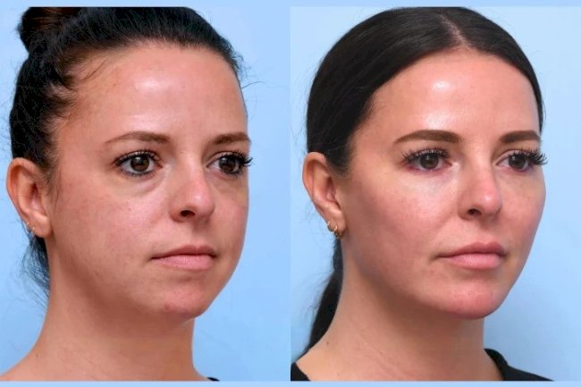 How to Find the Best Doctors in Dubai for a Non-Surgical Thread Lift