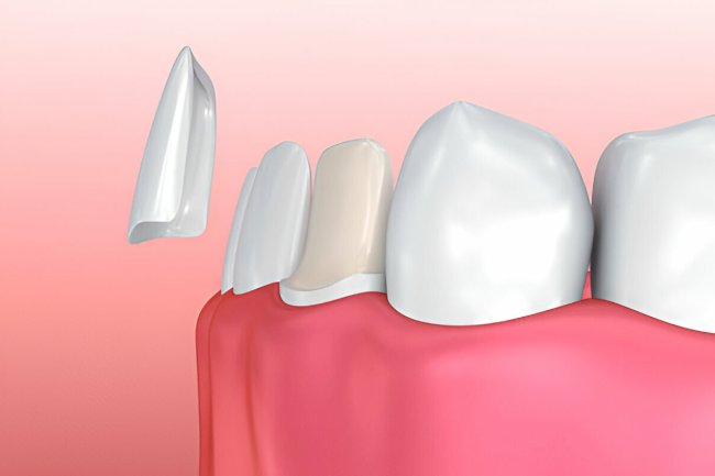 Everything You Need to Know About Porcelain Veneers at Gentle Dentistry of Las Colinas in Irving, TX