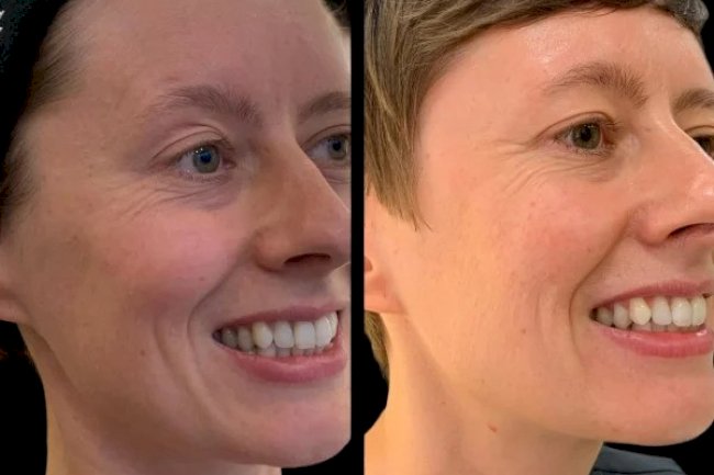 The Best Doctors in Dubai for Profhilo Understanding the Procedure and Its Benefits