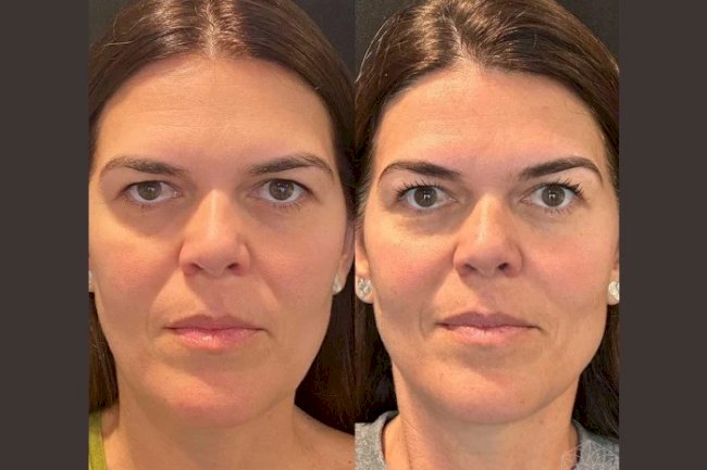 Thread Lifts Explained: Why the Best Doctors in Dubai Trust This Treatment
