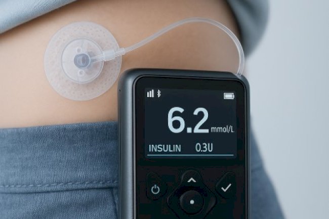 Welcome to Aidex CGM: Revolutionizing Diabetes Care with Automatic Pumps for Insulin Dependent Patients