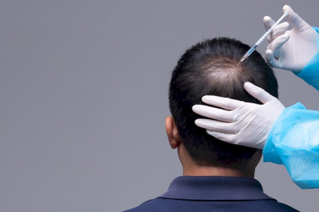 Can Minoxidil Help Regrow Hair? Detailed Insights for Men and Women