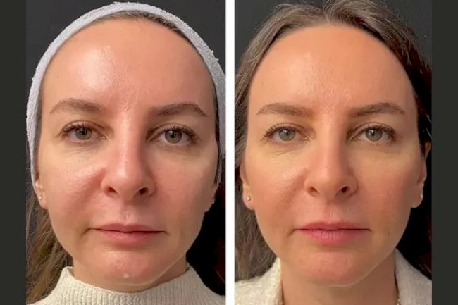 Top Reasons to Choose Mesotherapy at the Best Aesthetic Clinic in Dubai