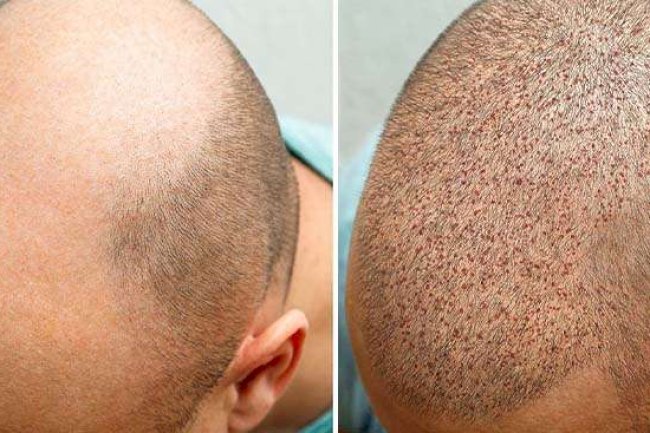 DHI Hair Restoration Albania: De Slimme Keuze voor Britten met Haarverlies