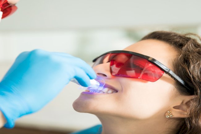 Top 5 Reasons to Choose Professional Teeth Whitening Over Store-Bought Kits