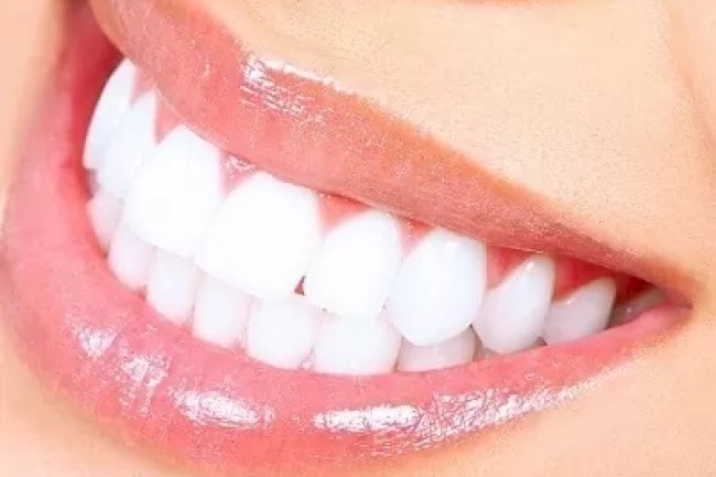 How Teeth Whitening Cost Matches Expectations