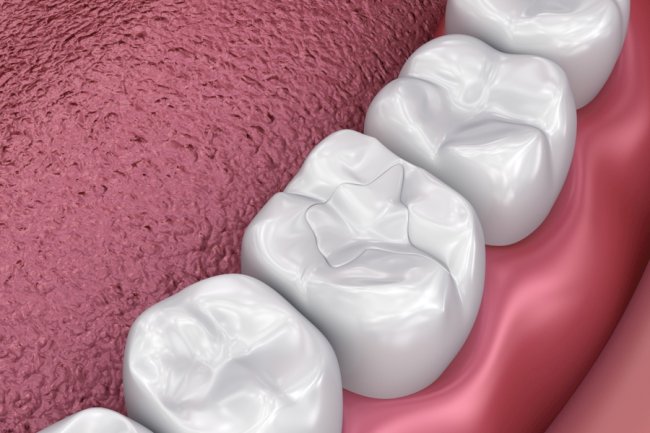 What’s the Best Filling Material for Front Teeth