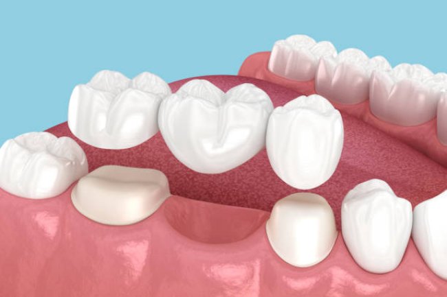 When Should You Replace an Old Dental Bridge