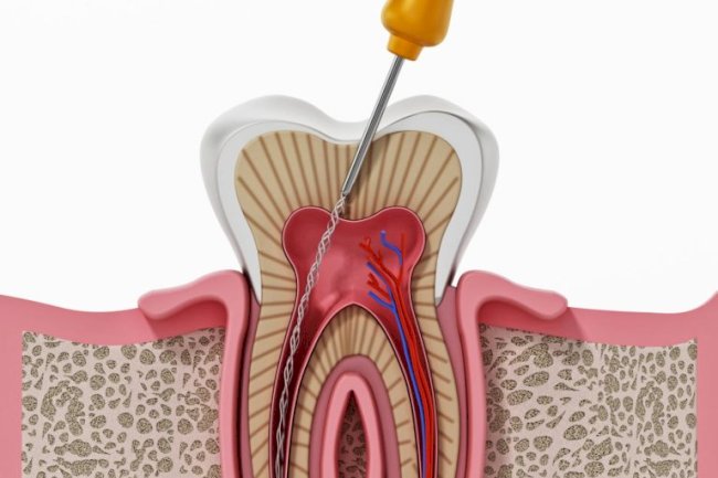 Root Canal Treatment Specialist Near Me: Expert Tooth Care at Dr. Neetu’s Multi Speciality Dental Clinic, Panchkula