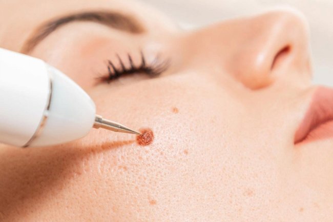 Skincare Routine After Warts Removal in Islamabad