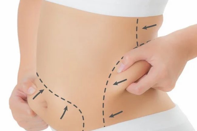 Tummy Tuck and Diastasis Recti: Real Repair for Core Muscles