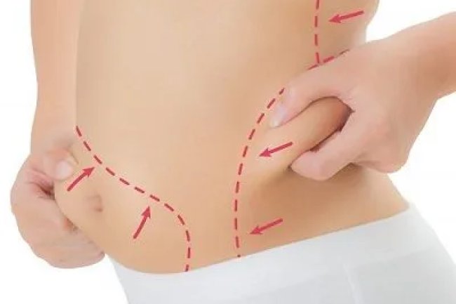 How to Estimate Your Liposuction Cost in Dubai Accurately
