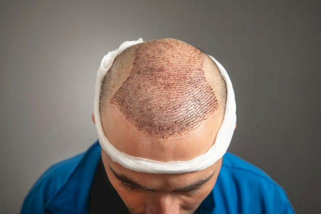 Who is the ideal candidate for a hair transplant?