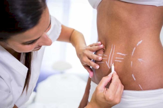 Free vs. Paid Liposuction Consultations in Islamabad