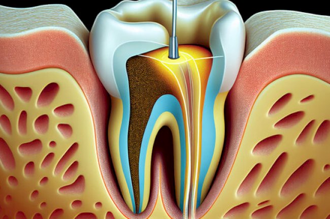 Best Root Canal Specialists in Islamabad: 2025 Guide