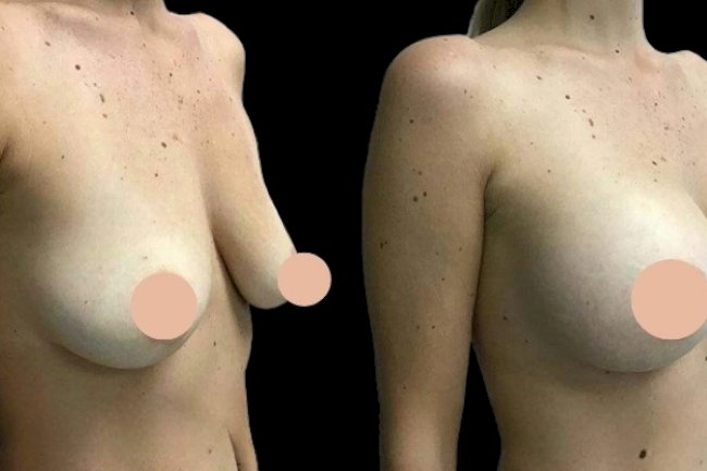 Why Safety Comes First with the Best Doctors in Dubai for Breast Augmentation Surgery