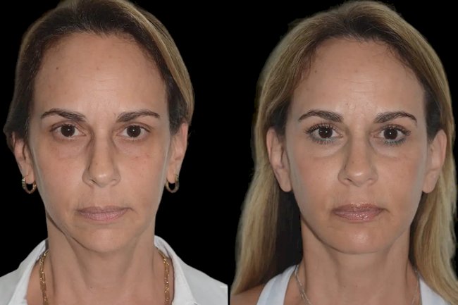 Best Aesthetic Clinics in Dubai for Chin Fillers: Enhance Your Facial Contours