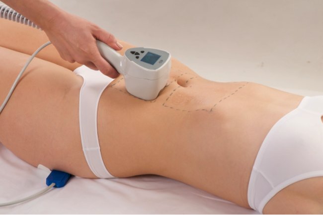 How Many Sessions Are Needed for Exilis Treatment?