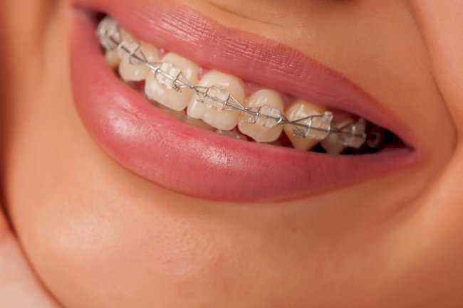 6 Common Braces Problems and How to Fix Them