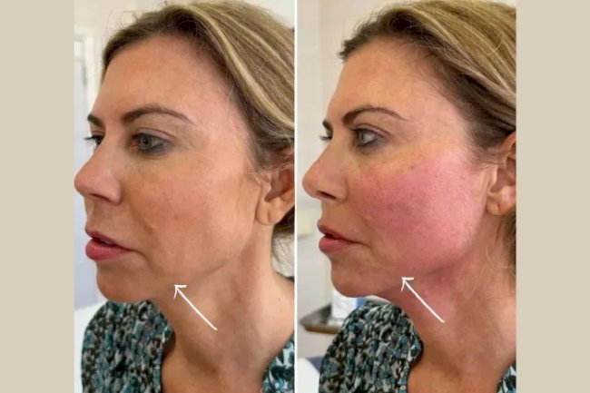What to Expect During Your First Endolift in Dubai Treatment
