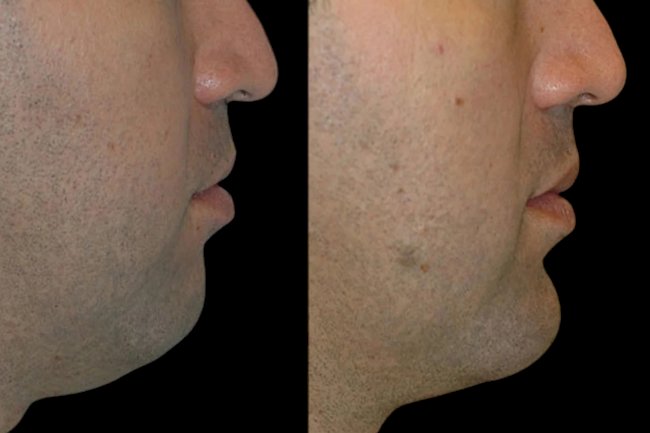 A Step-by-Step Guide to Chin Fillers with the Best Plastic Surgeon in Dubai