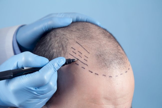 Can You Get a Crown Hair Transplant at Age 25?