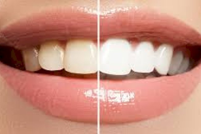 How to Budget for Teeth Whitening Cost Without Surprises