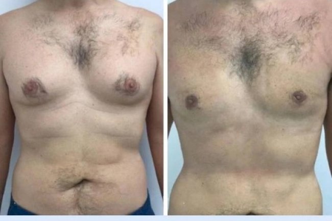 Gynecomastia Surgery In Dubai: Stunning Before and After Transformations
