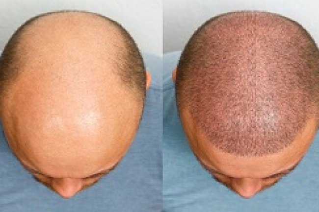 فوائد زراعة الشعر في الرياض مقارنة بالعلاجات الأخرى