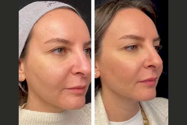 Mesotherapy Treatment in Dubai for Glowing Skin: How It Works