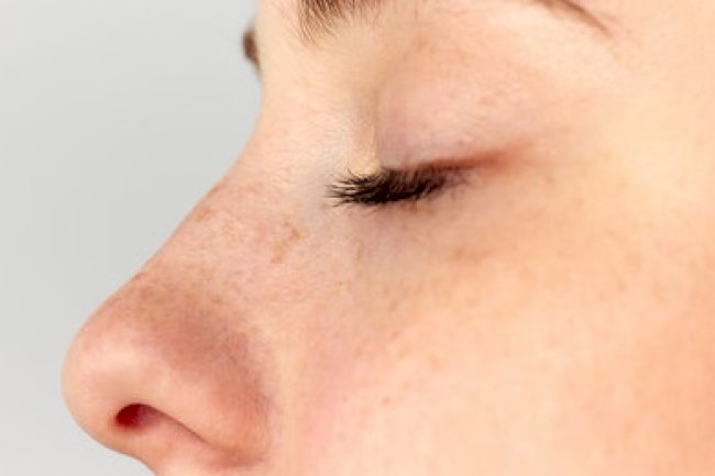 What is Rhinoplasty in Islamabad? A Complete Beginner’s Guide
