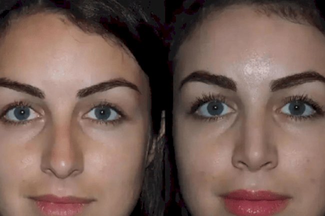 Expert Surgeons for Septoplasty in Dubai