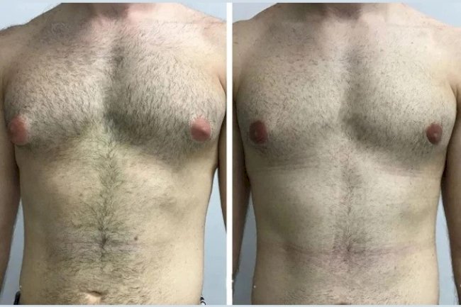 Treating Gynecomastia in Dubai with Hormone Therapy