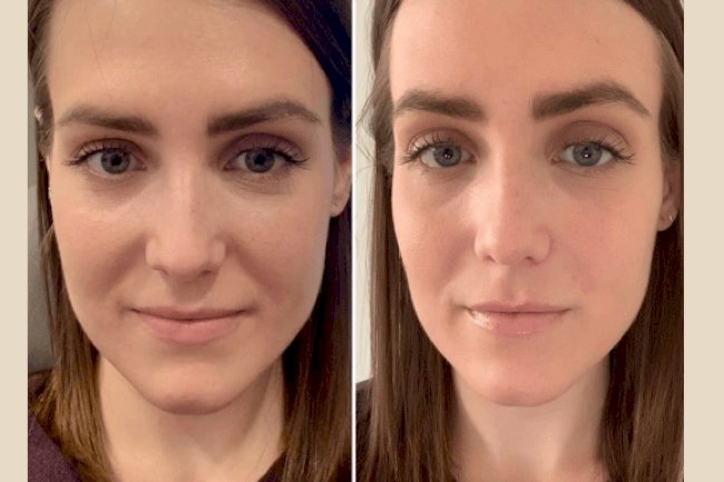 PRP Treatment in Dubai: What to Expect During Your First Session