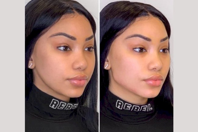 Enhance Confidence Through Affordable Thread Lift Treatments in Dubai Options