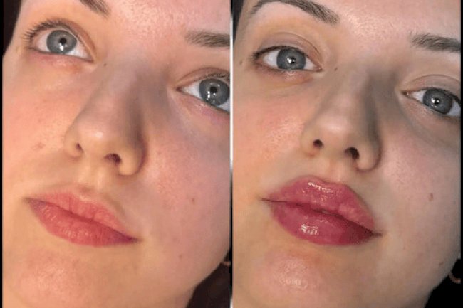 Best Plastic Surgeons in Dubai Known for Precision in Dermal Fillers