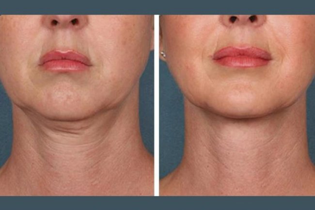 Best Doctors in Dubai for Affordable PRP Treatment