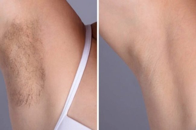 Laser hair removal in Dubai: Benefits for Men and Women
