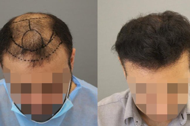 زراعة الشعر في دبي: حيث تلتقي الرفاهية بالنتائج الطبيعية المذهلة