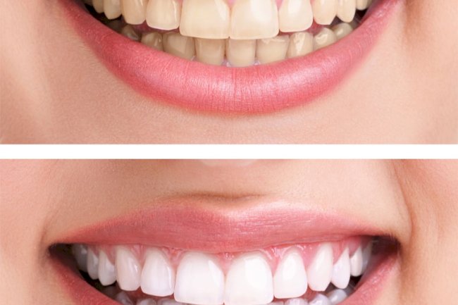 Fast Teeth Whitening Solutions in Islamabad