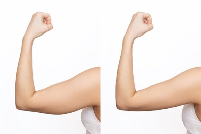 Why "Ozempic Body" Patients are Flocking to Arm Lift Surgery in Riyadh
