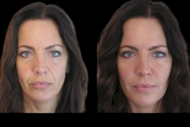 Best Plastic Surgeons in Dubai for Non-Surgical Jawline Perfection