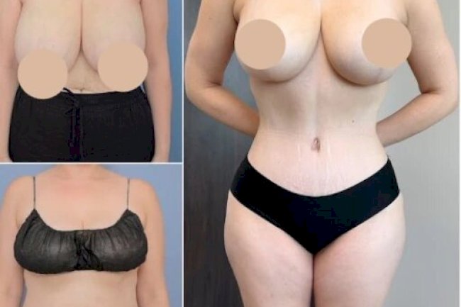 Best Doctors in Dubai for Tummy Tuck and Safe Fat Removal