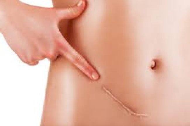 Steroid Injections for Keloids in Islamabad: What You Need to Know