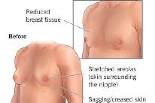 Tips to Manage Gynecomastia Surgery Cost in Islamabad Without Compromising Safety