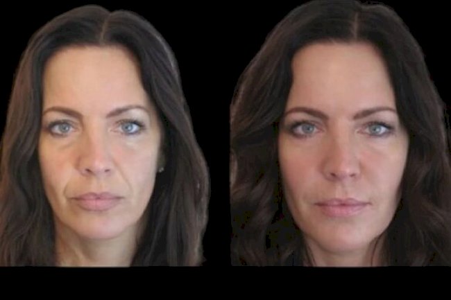 Best Plastic Surgeons in Dubai for Jawline Perfection with Jawline Fillers