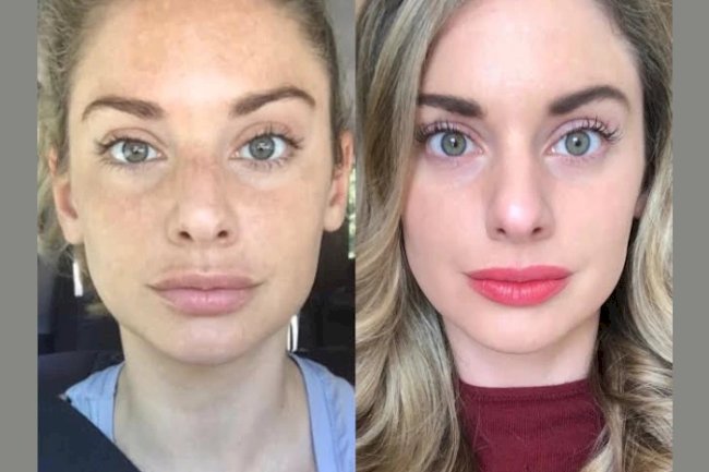 Non-Surgical Skin Lifting by the Best Plastic Surgeons in Dubai for Radiofrequency (RF) Microneedling